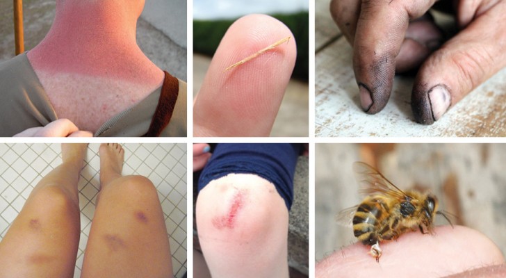 8 natürliche Hausmittel gegen Kratzer, Splitter, blaue Flecken